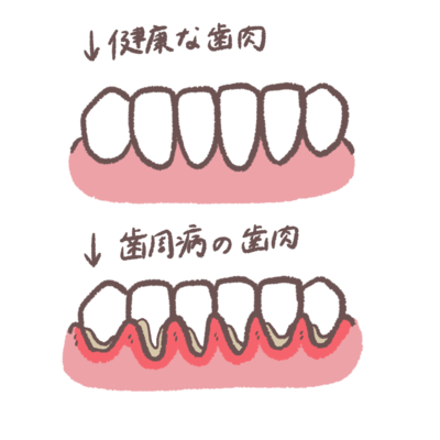 歯周病の症状