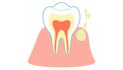歯周病の症状