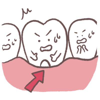 歯周病の症状